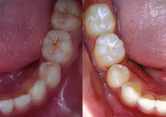窩溝封閉、涂氟防蛀